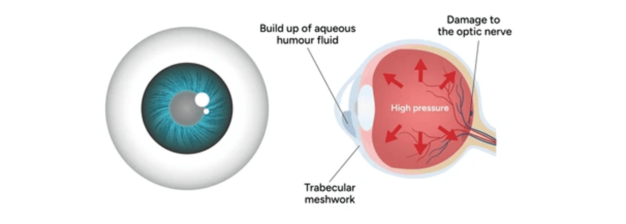 Glaucome_pression_dans_l_oeil