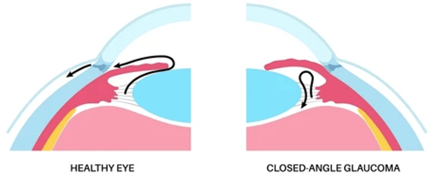 schéma_angle_iridocornéen