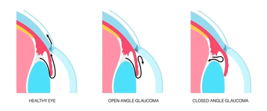 schéma_fermeture_angle_iridocristalinien 